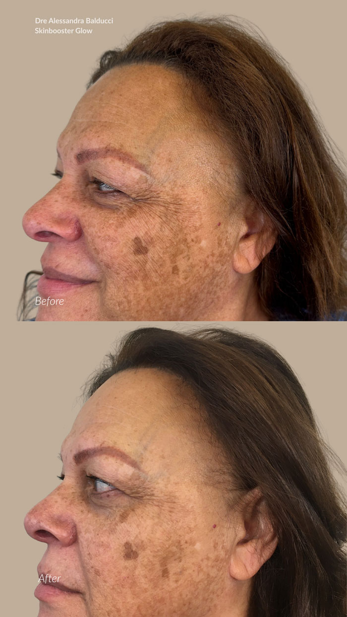 before-after-skinbooster-2