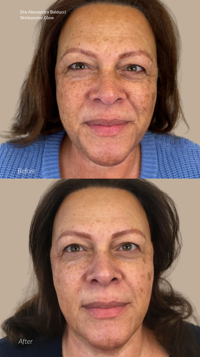 before-after-skinbooster-3