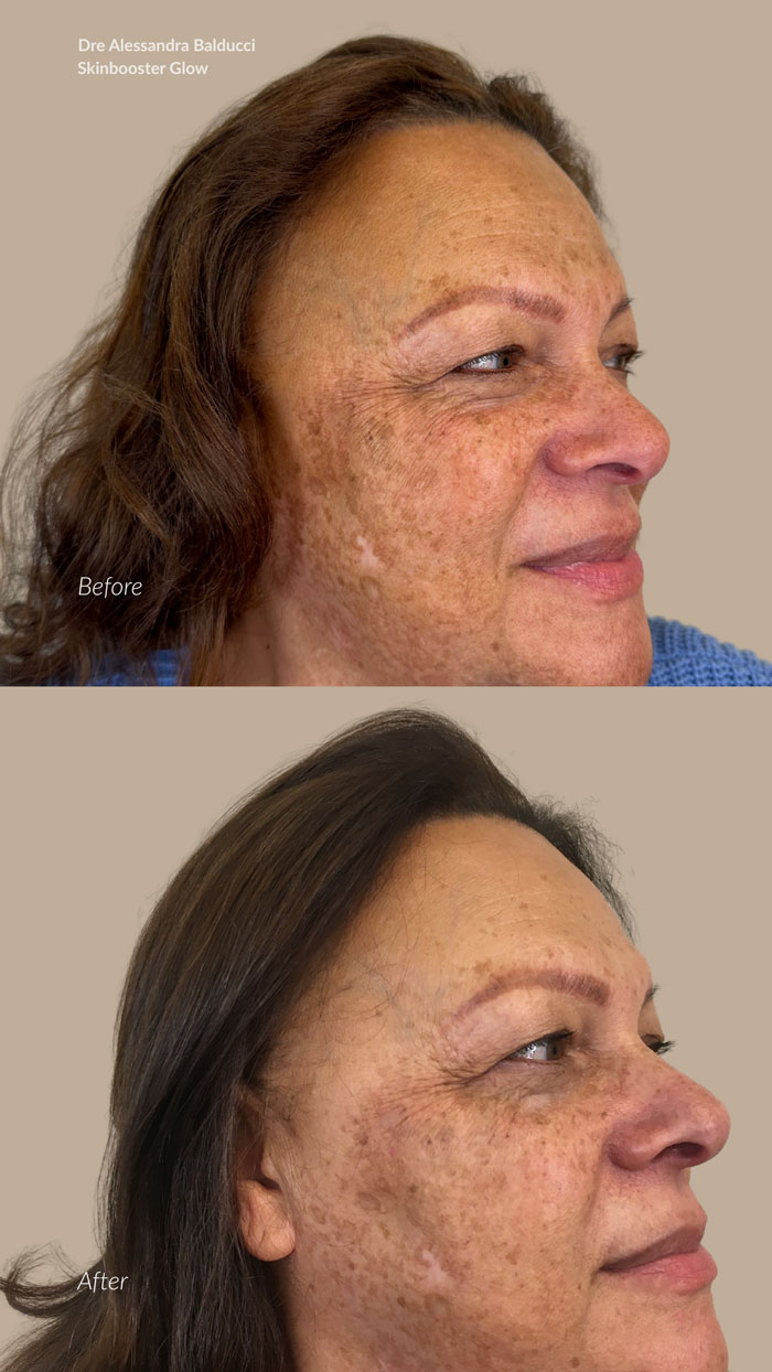 before-after-skinbooster