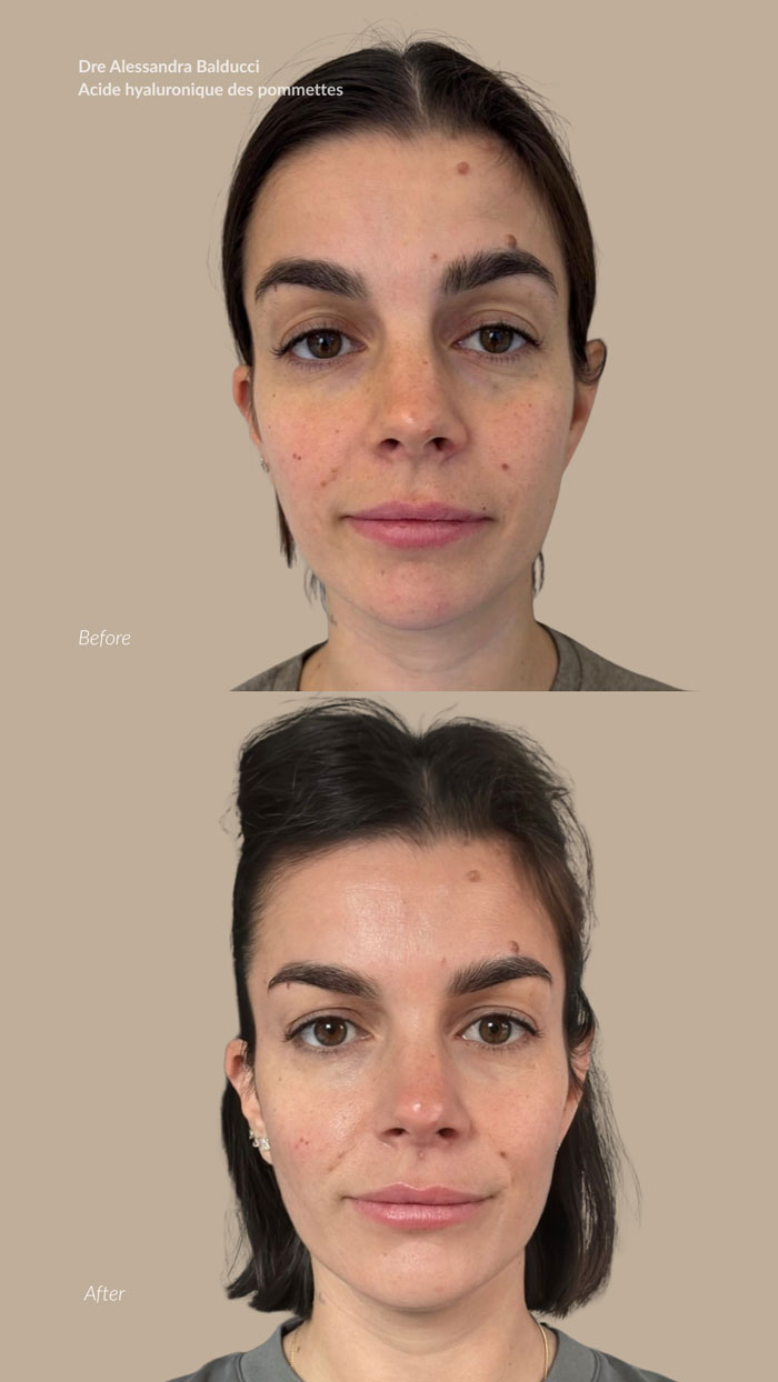 before-after-acide-hyaluronique-2