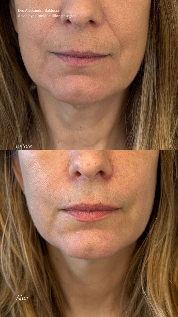 before-after-acide-hyaluronique-4