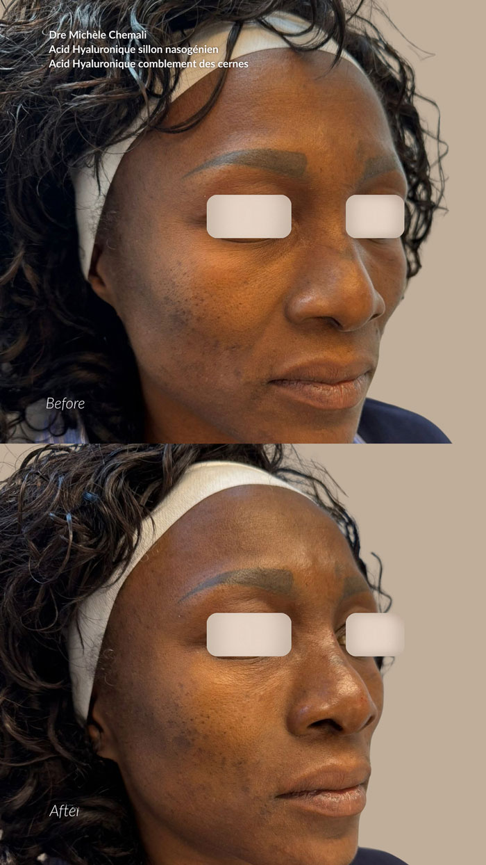before-after-acide-hyaluronique