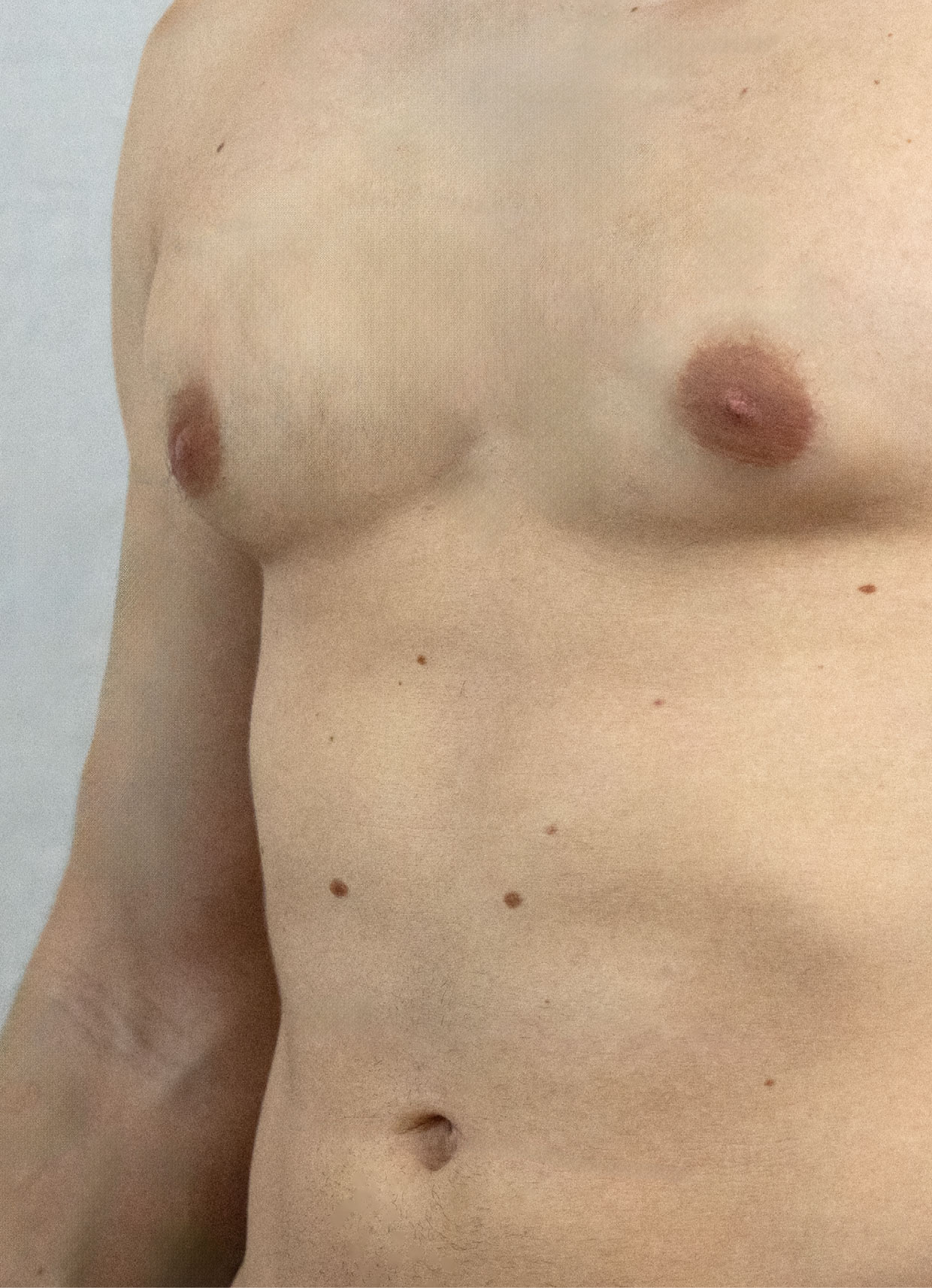 Abdominoplastie