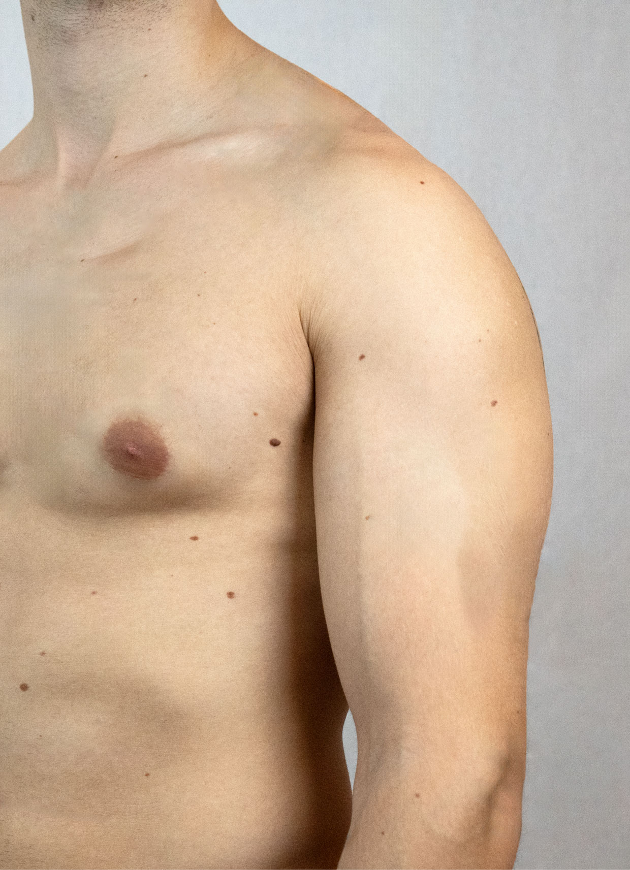 Gynäkomastie – Brustverkleinerung für den Mann