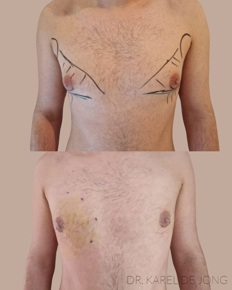 gynecomastie-1