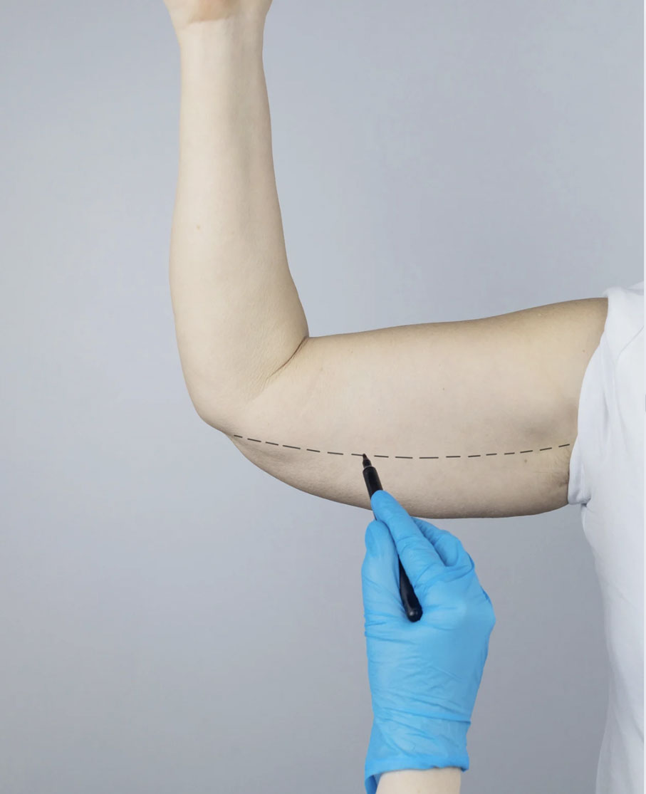 Lifting des bras