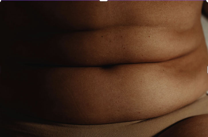 Abdominoplastie
