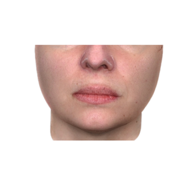lipolyse-after-before