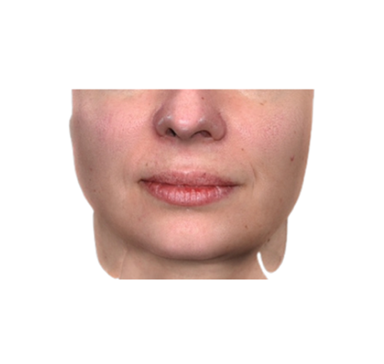 lipolyse-after-before