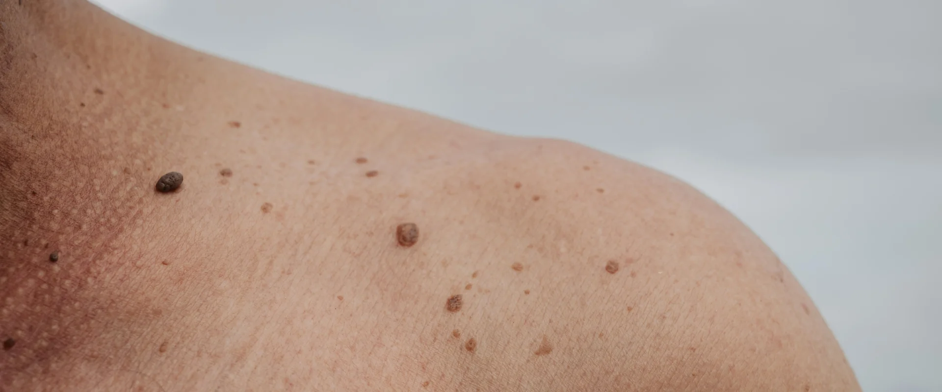 Nahaufnahme der Schulter einer Person mit mehreren unterschiedlich grossen, braunen Muttermalen