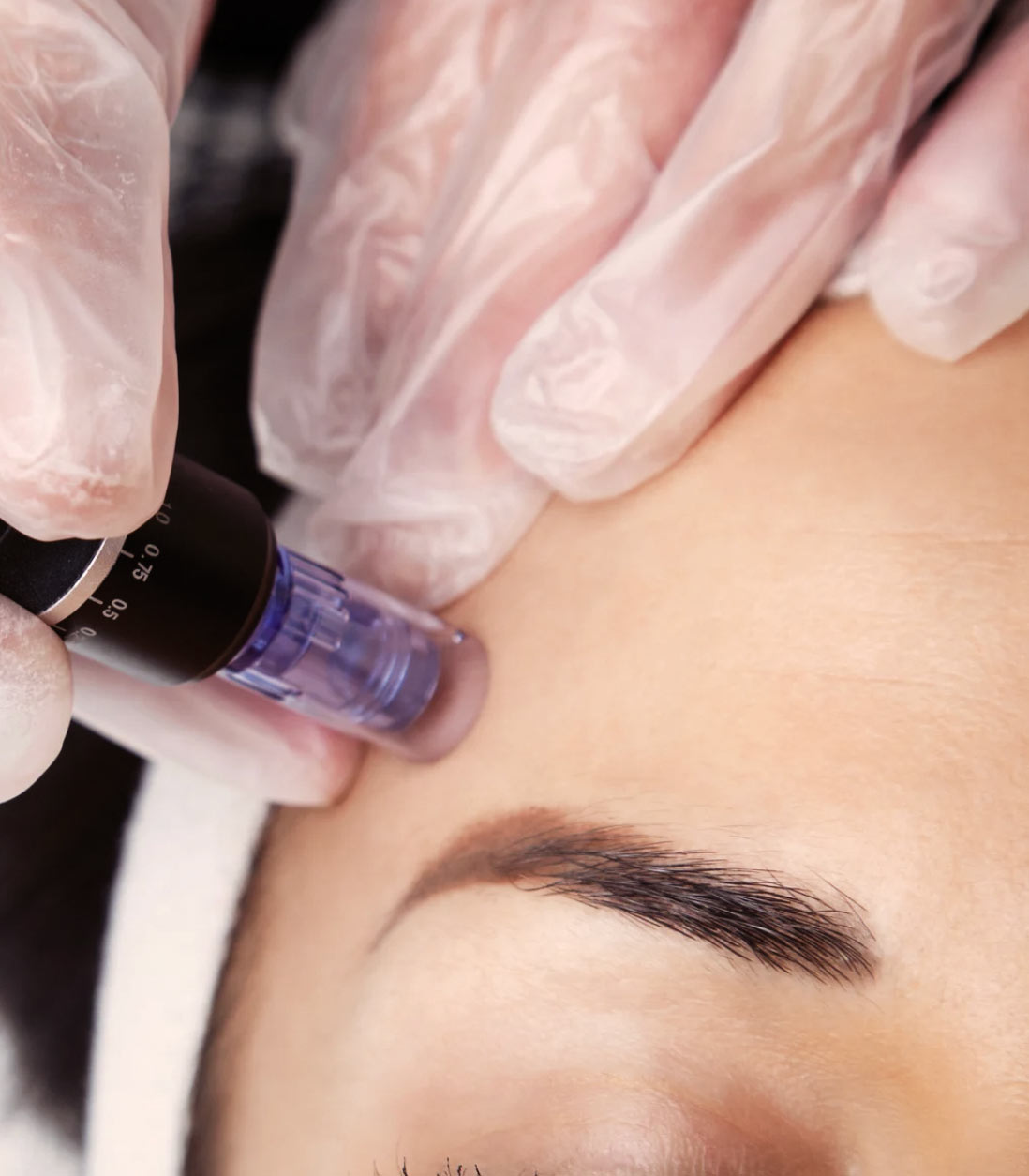 Microneedling médical