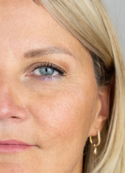 IPL / Laser Behandlung